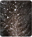 Flaking Dandruff