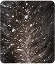 Flaking Dandruff
