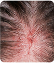 Irritated Scalp