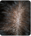 Thinning Hair