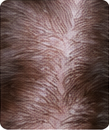 Dry Scalp