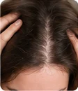 Hair Density